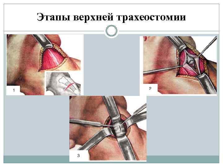 Этапы верхней трахеостомии 