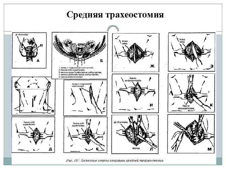 Средняя трахеостомия 