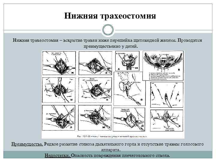 Нижняя трахеостомия – вскрытие трахеи ниже перешейка щитовидной железы. Проводится преимущественно у детей. Преимущества.