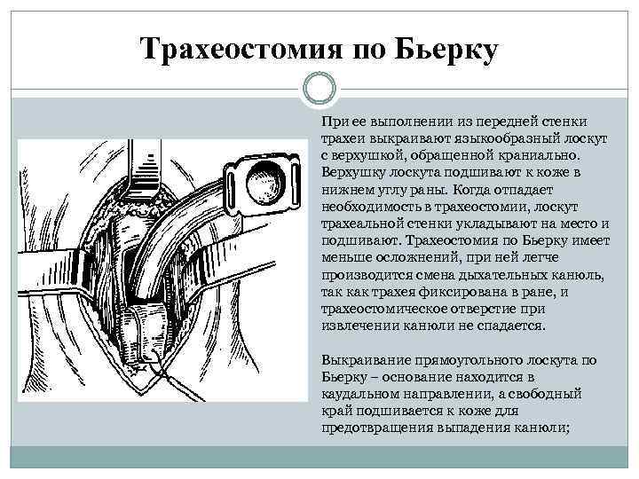 Трахеостомия по Бьерку При ее выполнении из передней стенки трахеи выкраивают языкообразный лоскут с