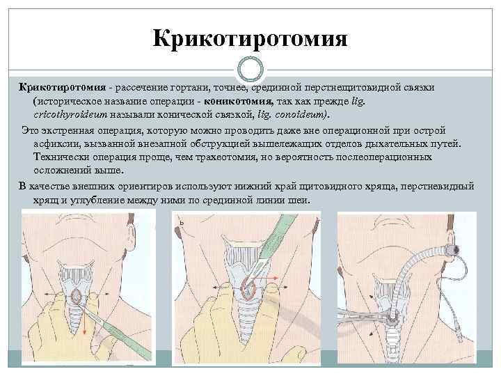 Крикотиротомия рассечение гортани, точнее, срединной перстнещитовидной связки (историческое название операции коникотомия, так как прежде