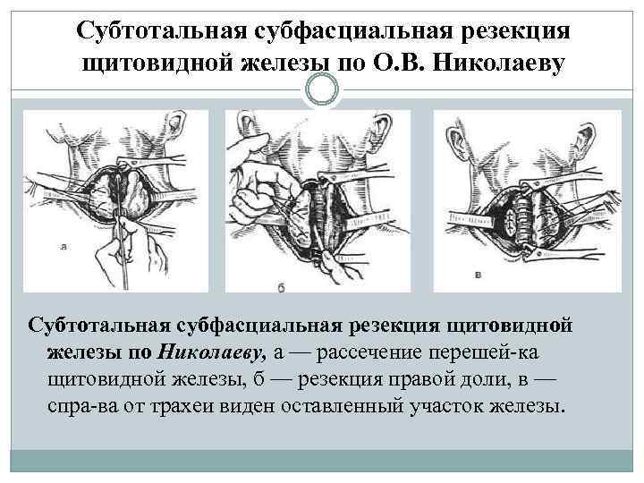 Субтотальная субфасциальная резекция щитовидной железы по О. В. Николаеву Субтотальная субфасциальная резекция щитовидной железы