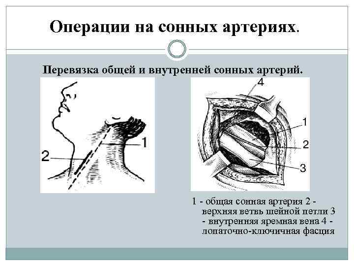 Операции на сонных артериях. Перевязка общей и внутренней сонных артерий. 1 общая сонная артерия