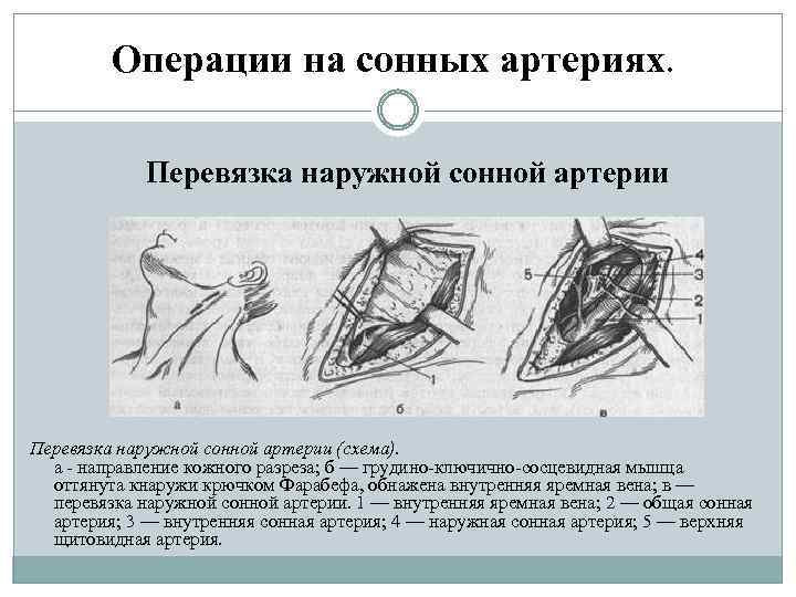 Операции на сонных артериях. Перевязка наружной сонной артерии (схема). а направление кожного разреза; б