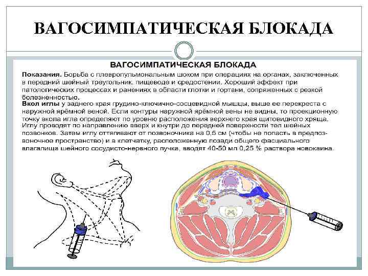 ВАГОСИМПАТИЧЕСКАЯ БЛОКАДА 