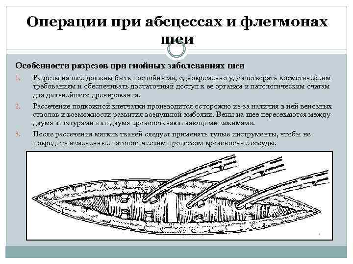 Операции при абсцессах и флегмонах шеи Особенности разрезов при гнойных заболеваниях шеи 1. 2.