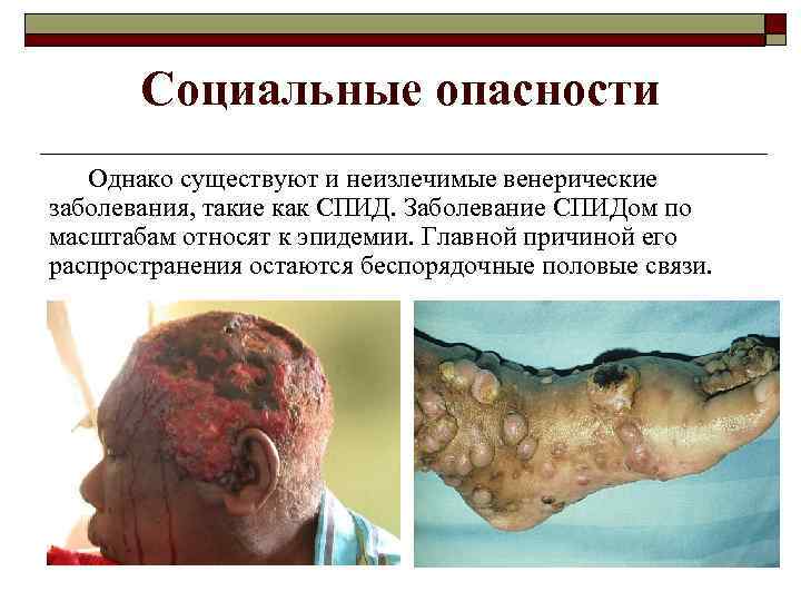 Социальные опасности Однако существуют и неизлечимые венерические заболевания, такие как СПИД. Заболевание СПИДом по