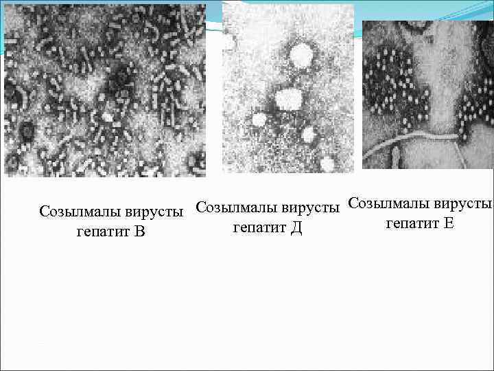 Созылмалы вирусты гепатит Е гепатит Д гепатит В 