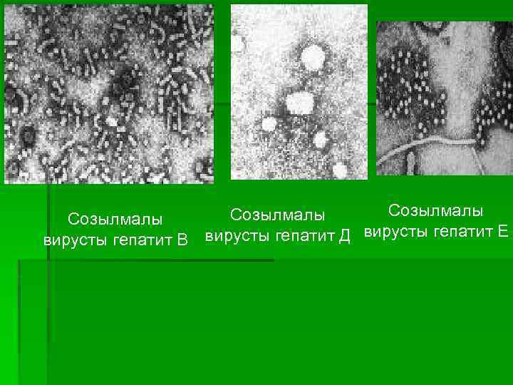 Созылмалы вирусты гепатит В вирусты гепатит Д вирусты гепатит Е 