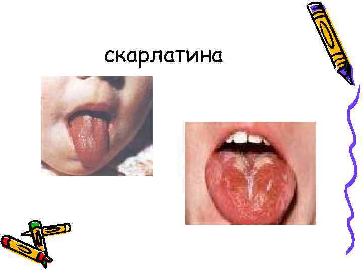 скарлатина 