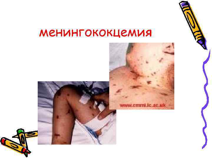 менингококцемия 