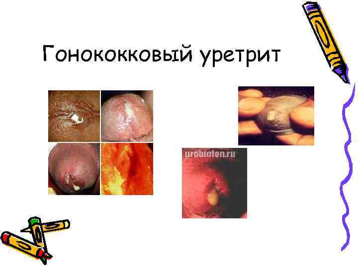 Гонококковый уретрит 