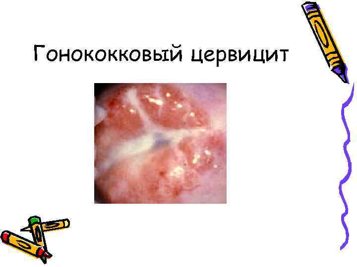 Гонококковый цервицит 