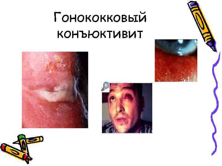 Гонококковый конъюктивит 