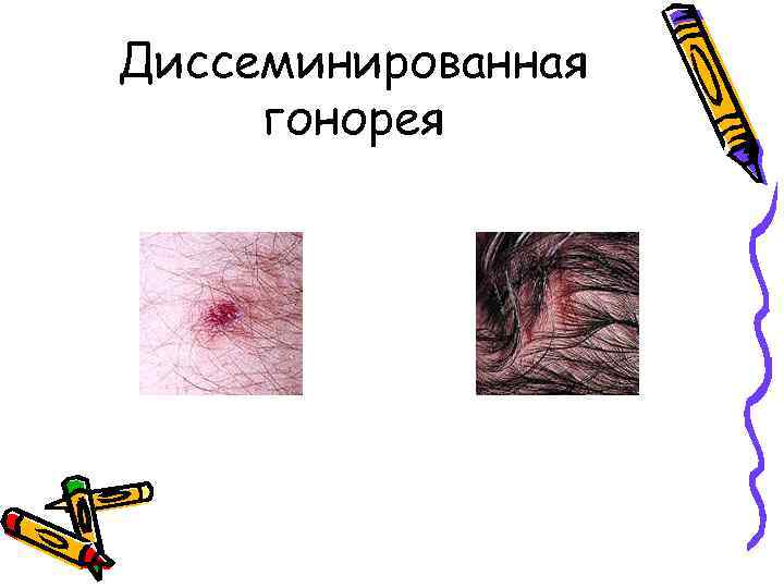 Диссеминированная гонорея 