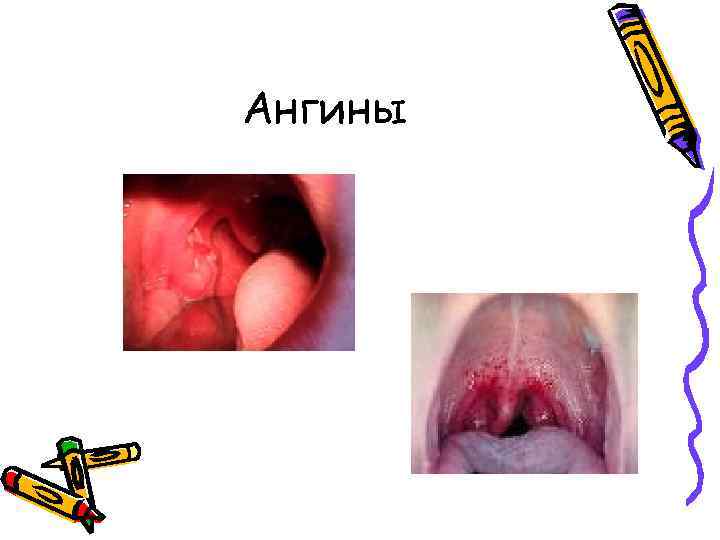 Ангины 