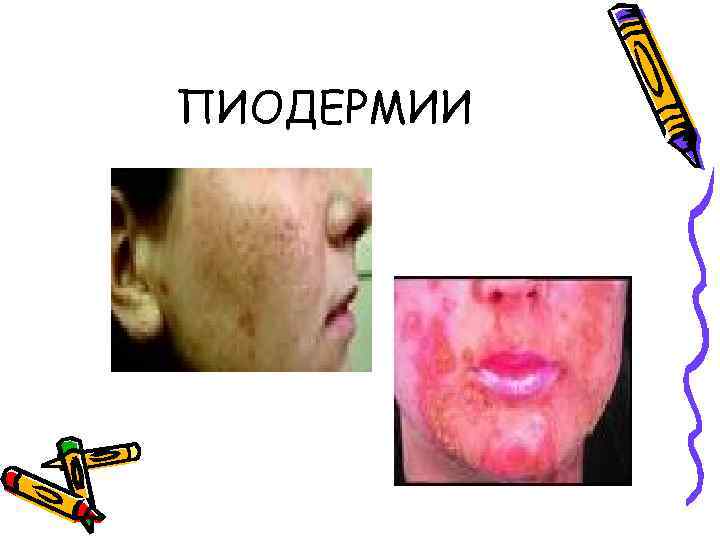 ПИОДЕРМИИ 