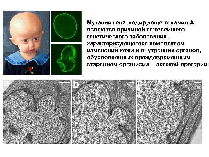 Какая мутация изображена на рисунке причиной какого заболевания является данная мутация