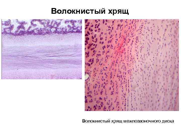 Субплевральный узел незрелой хрящевой ткани