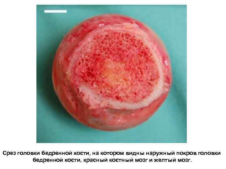 Срез головки бедренной кости, на котором видны наружный покров головки бедренной кости, красный костный