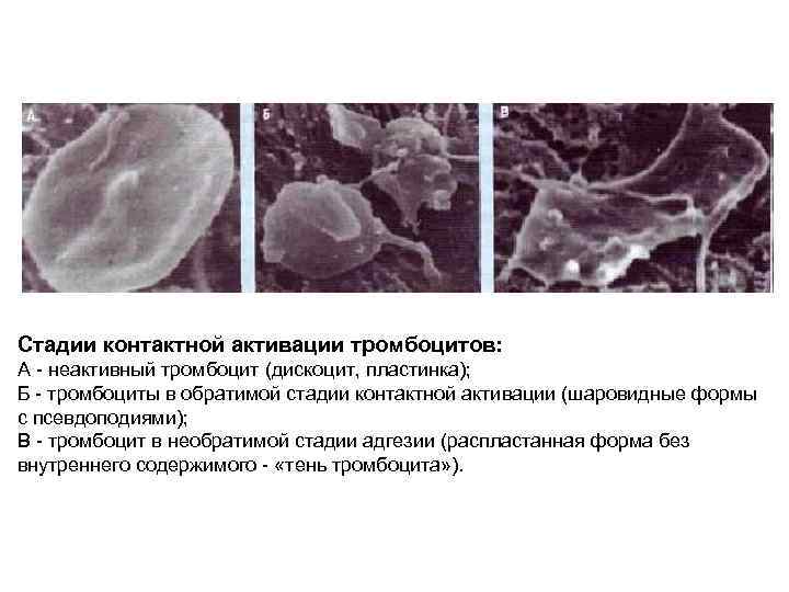 Стадии контактной активации тромбоцитов: А - неактивный тромбоцит (дискоцит, пластинка); Б - тромбоциты в