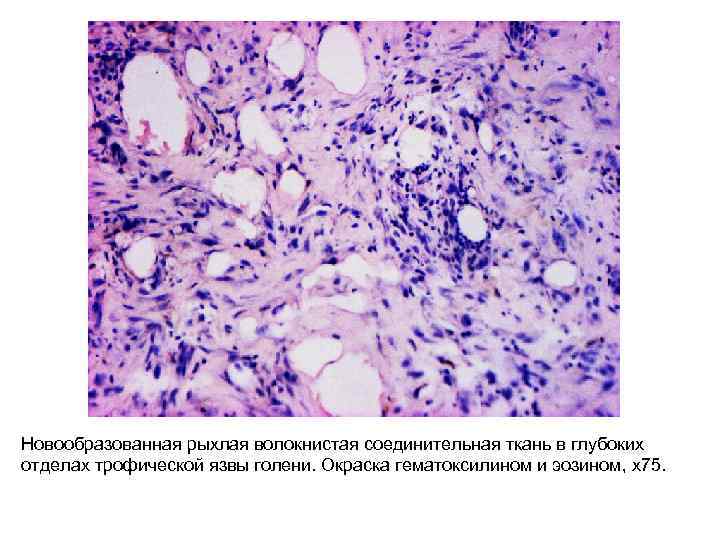Новообразованная рыхлая волокнистая соединительная ткань в глубоких отделах трофической язвы голени. Окраска гематоксилином и
