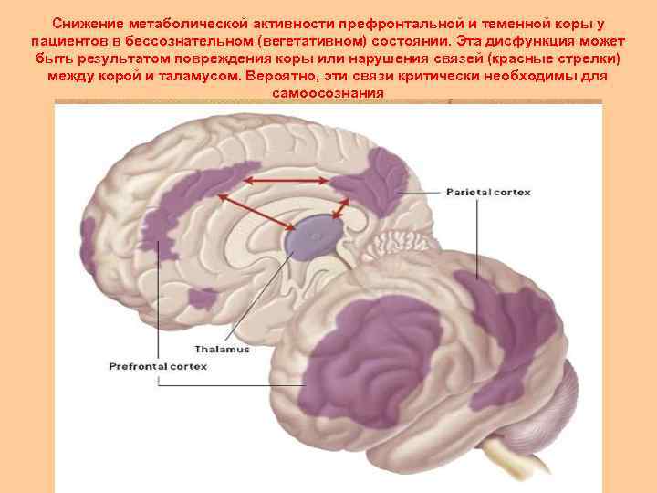 Снижение метаболической активности префронтальной и теменной коры у пациентов в бессознательном (вегетативном) состоянии. Эта