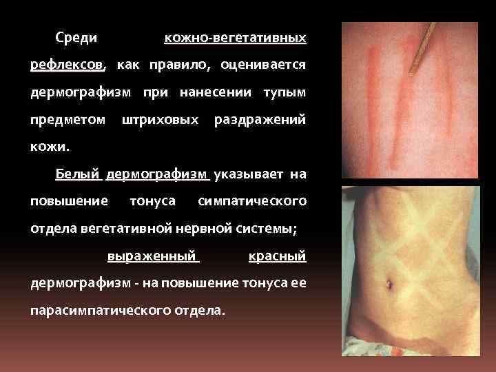 Среди кожно-вегетативных рефлексов, как правило, оценивается дермографизм при нанесении тупым предметом штриховых раздражений кожи.