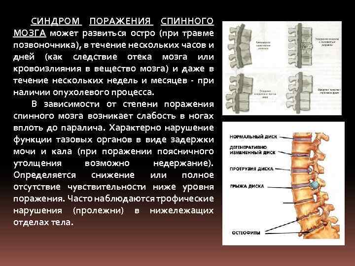 СИНДРОМ ПОРАЖЕНИЯ СПИННОГО МОЗГА может развиться остро (при травме позвоночника), в течение нескольких часов