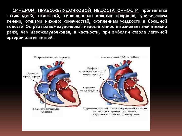 СИНДРОМ ПРАВОЖЕЛУДОЧКОВОЙ НЕДОСТАТОЧНОСТИ проявляется тахикардией, отдышкой, синюшностью кожных покровов, увеличением печени, отеками нижних конечностей,