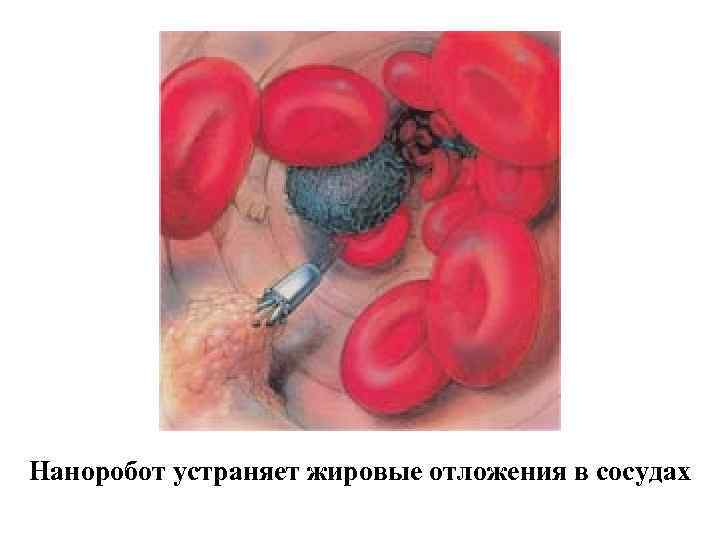 Наноробот устраняет жировые отложения в сосудах 
