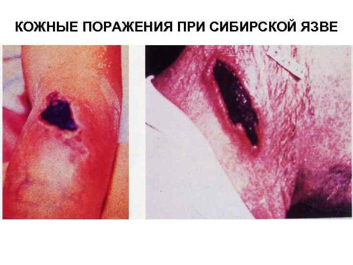 КОЖНЫЕ ПОРАЖЕНИЯ ПРИ СИБИРСКОЙ ЯЗВЕ 