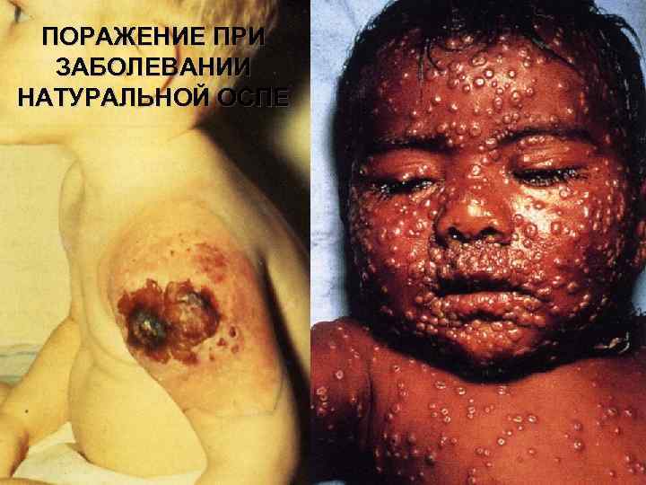 ПОРАЖЕНИЕ ПРИ ЗАБОЛЕВАНИИ НАТУРАЛЬНОЙ ОСПЕ 