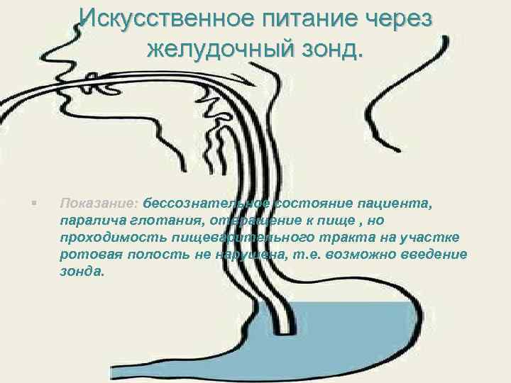 Искусственное питание через желудочный зонд. § Показание: бессознательное состояние пациента, паралича глотания, отвращение к