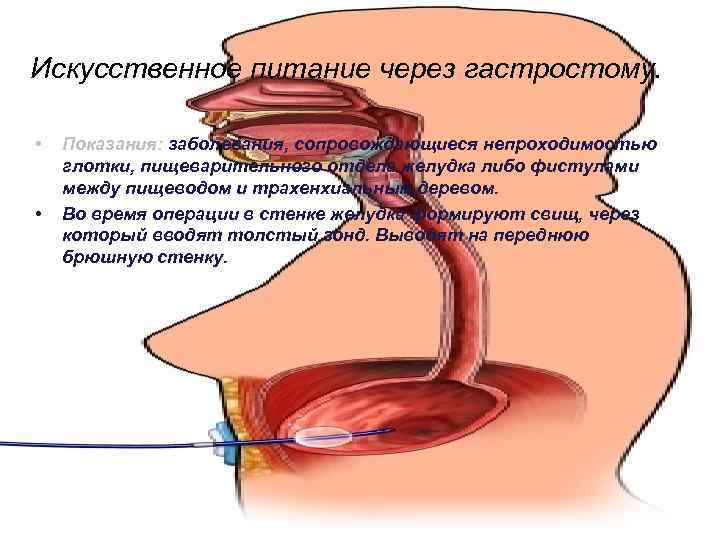 Искусственное питание через гастростому. • • Показания: заболевания, сопровождающиеся непроходимостью глотки, пищеварительного отдела желудка