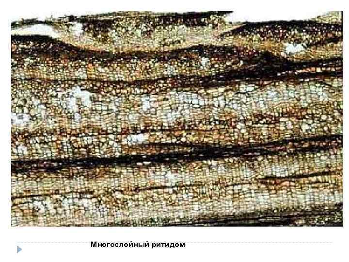 Многослойный ритидом 
