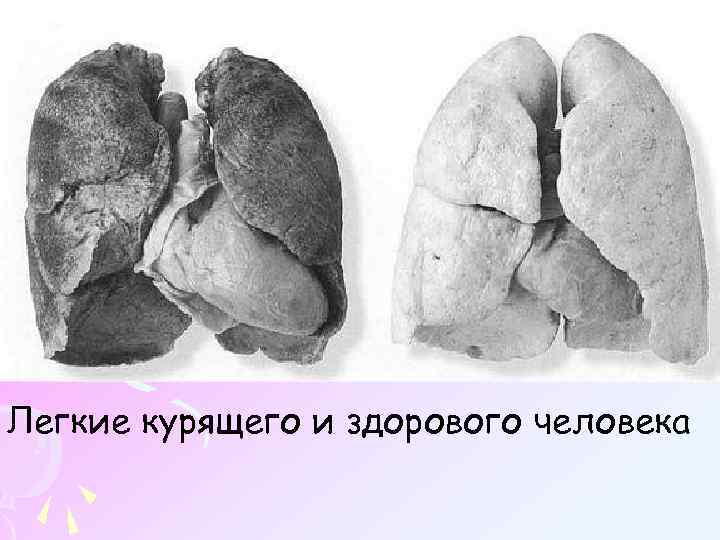Легкие курящего и здорового человека 
