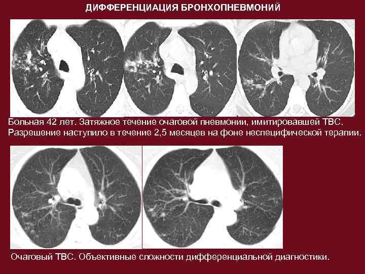 Кт картина пневмонии