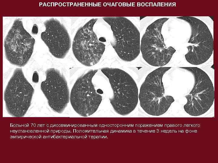 Очаговые изменения в легких на кт. Очаговая бронхопневмония кт. Пневмоцистная пневмония на кт.