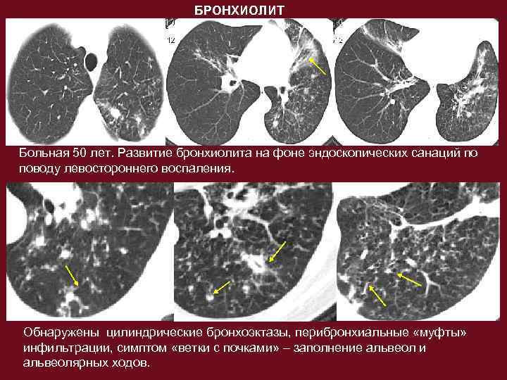 Диагностика бронхиолита