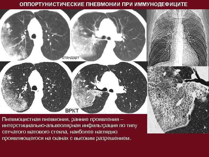 Пневмония на фоне иммунодефицита