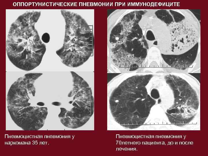 Пневмоцистная пневмония диагноз