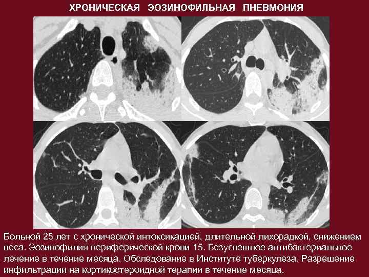 Легочная эозинофилия. Эозинофильная инфильтрация легких кт. Хроническая эозинофильная пневмония кт. Эозинофильный инфильтрат легкого кт.