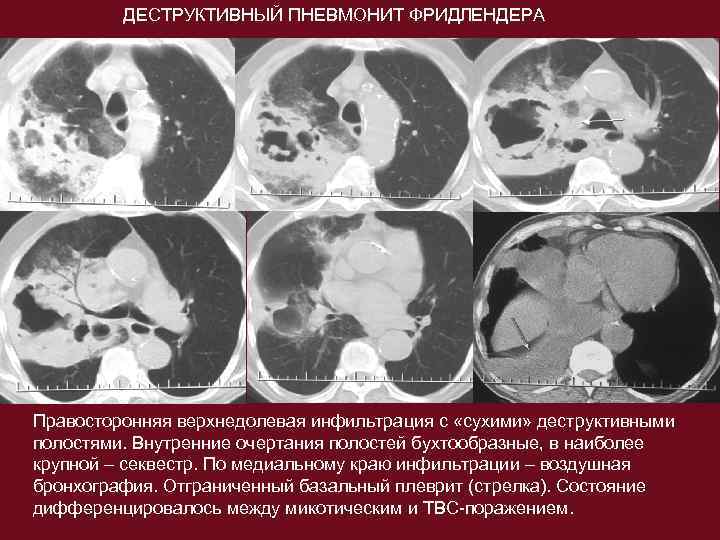 В каких случаях показана компьютерная рентгеновская томография пораженного сустава тест