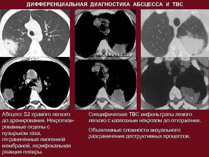 Абсцесс легкого кт картина