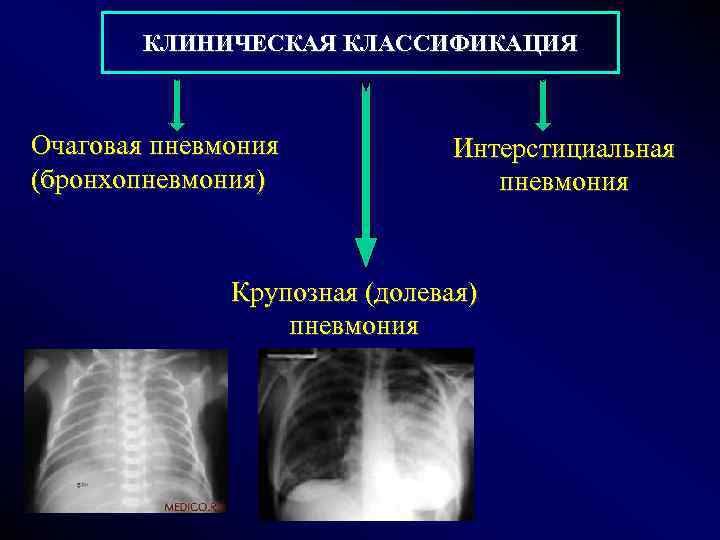 КЛИНИЧЕСКАЯ КЛАССИФИКАЦИЯ Очаговая пневмония (бронхопневмония) Интерстициальная пневмония Крупозная (долевая) пневмония 