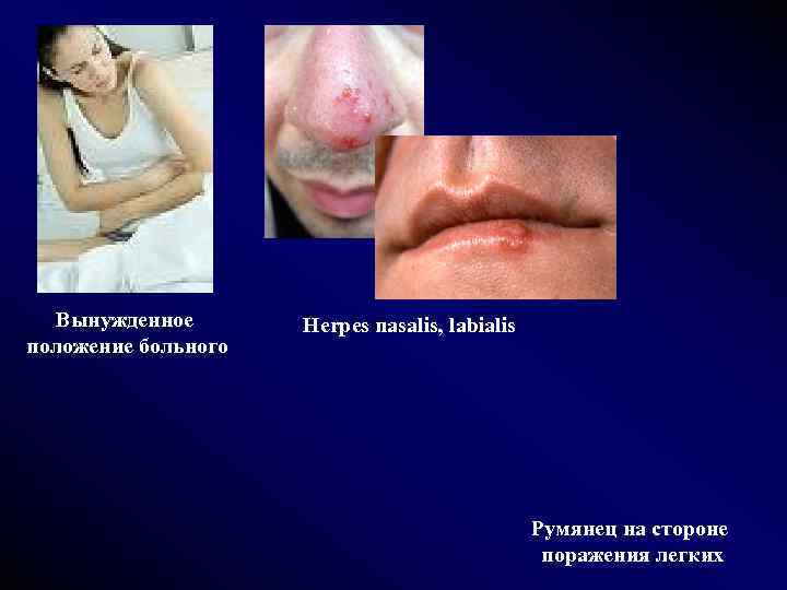 Вынужденное положение больного Herpes nasalis, labialis Румянец на стороне поражения легких 