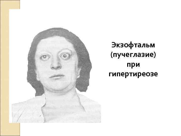 Экзофтальм (пучеглазие) при гипертиреозе 