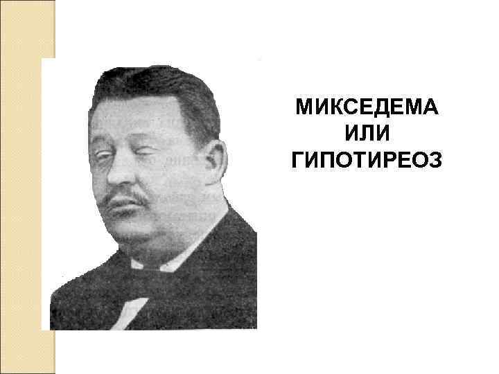 МИКСЕДЕМА ИЛИ ГИПОТИРЕОЗ 