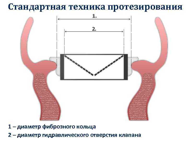 Стандартная техника протезирования 1 – диаметр фиброзного кольца 2 – диаметр гидравлического отверстия клапана